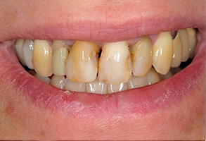 Miami Lakes Before and After Braces